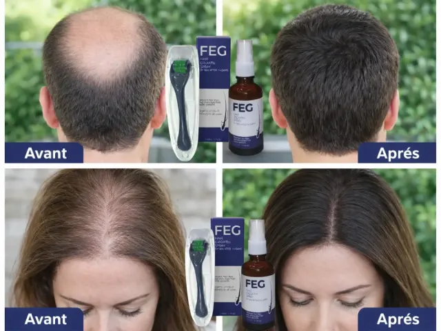 FEG Plus – Solution Avancée pour la Croissance des Cheveux.